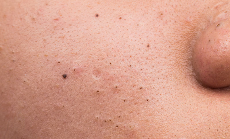 How to Treat Blackheads, Blackhead Causes Prevention and Remedy