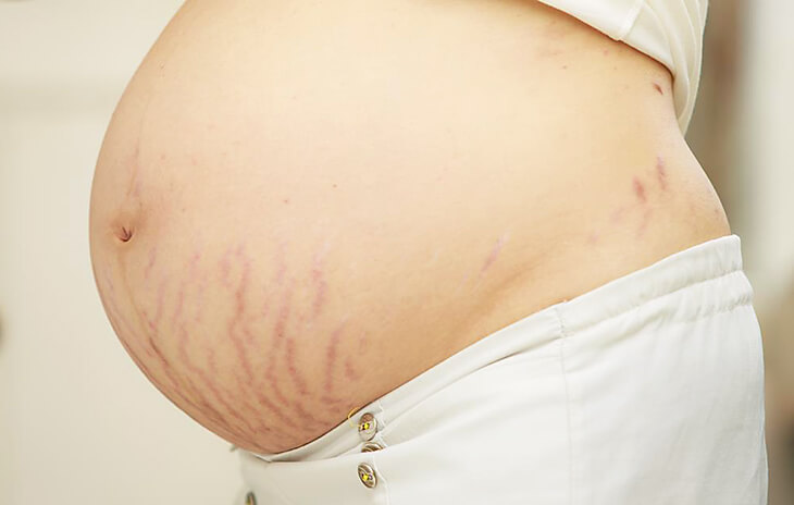 Why Stretch Marks Occurs and How to Get Rid of Stretch Marks