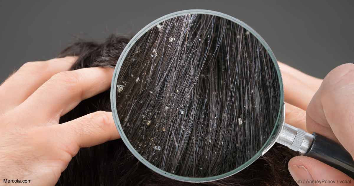 How to Get Rid of Dandruff Simple Home Remedies and Tips with VIDEO