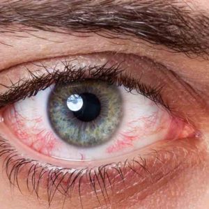 What Causes Red Eye and How to Get Rid of Red Eye