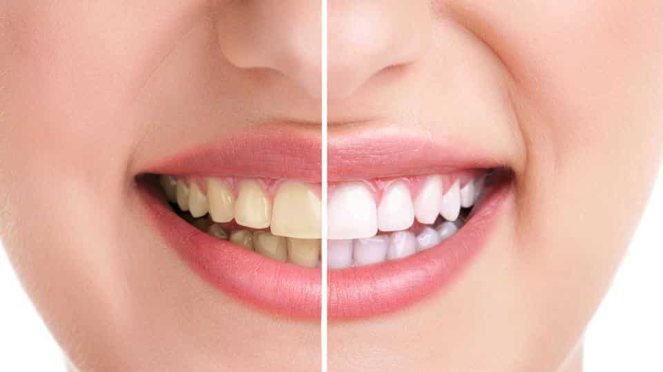 Foods That Naturally Whiten Teeth